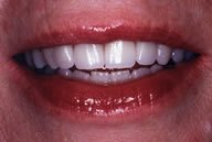 Teeth are Whiter and Brighter with Dental Crowns