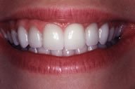 Nikki's Smile After