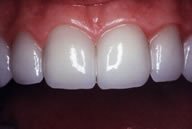 Nikki's Teeth After