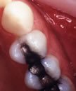Before Composite Fillings