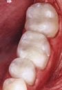Natural Look of Tooth Colored Composite