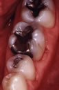 Prior to Tooth Colored Composite