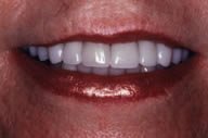 Sue's Smile After