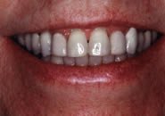 Sue's Smile Before