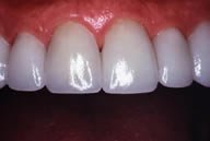 Sue's Teeth After