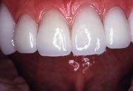 After Dental Crown Placement