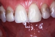 Before Dental Crown Placement