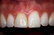 Jayne's Teeth Before Porcelain Veneers