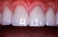 Teeth Reshapen with the Use of Porcelain Veneers