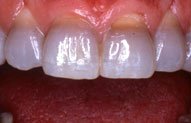Teeth Can be Reshapen Using Porcelain Veneers