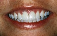MiMi's Smile After