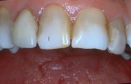 Discolored Teeth Can Be Fixed with Porcelain Veneers