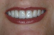 Gail's Smile After