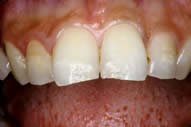 Shoba's Teeth Before Veneers