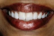 Shoba's Smile After Porcelain Veneers