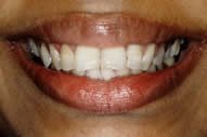 Shoba's Smile Before Porcelain Veneers
