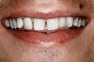 Gaps Between Teeth Prior to Dental Crown Placement